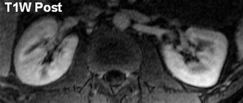 Characterization Of Genitourinary Lesions With Diffusion Weighted