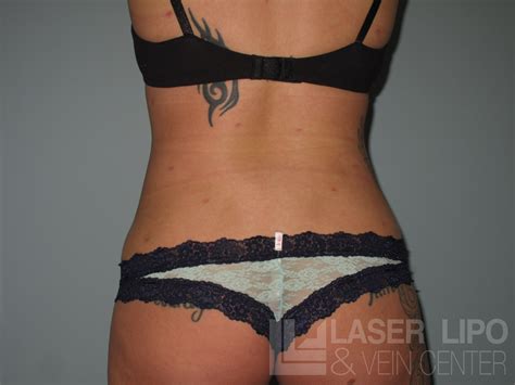 Pin On Laser Liposuction