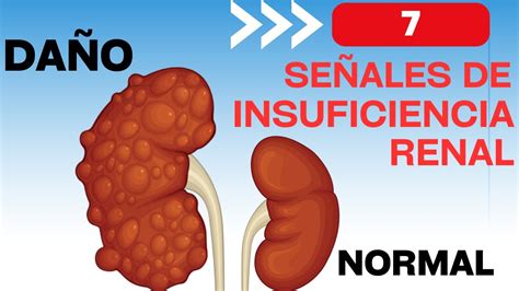 Se Ales De Que Tendr S Insuficiencia Renal Youtube