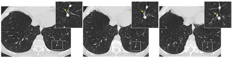 Luminal Mucus Plugs Are Spatially Associated With Airway Wall