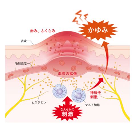 蕁麻疹（じんましん） 南草津皮フ科 南草津駅徒歩7分 一般皮膚科・美容皮膚科