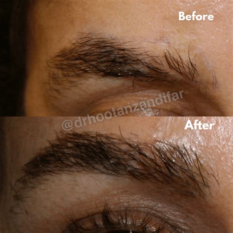 Eyebrow Transplant Procedure Beverly Hills and Los Angeles CA