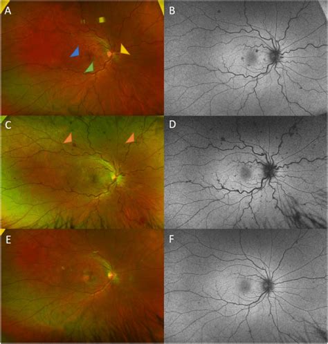 Wide Field Fundus Photos And Fundus Autofluorescence Of The Right Eye