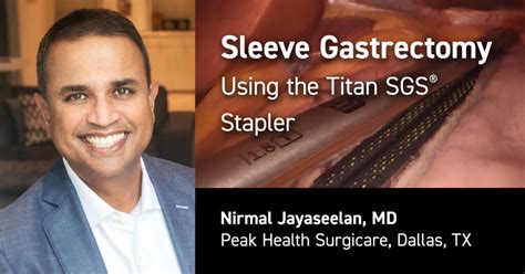 Nirmal Jayaseelan Sleeve Gastrectomy Using Titan Sgs Stapler