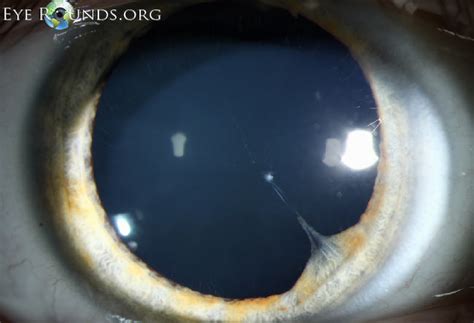 Persistent Pupillary Membrane The University Of Iowa Ophthalmology