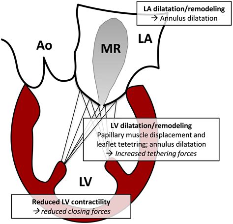 Leaflet Of Mitral Valve