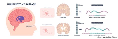 Huntingtons Disease Symptoms Vary By Age At Onset Physicians Weekly