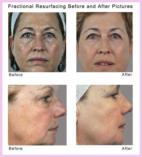 Erbium Fractional Laser Skin Resurfacing - BEAUTYWORKS