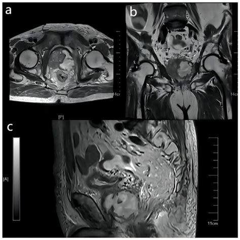 Pretreatment Magnetic Resonance Imaging Examination Of The Prostate