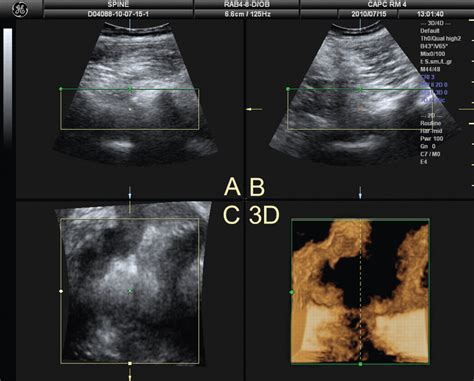 Feasibility Study Of Real Time Three Four Dimensional Ultrasound For