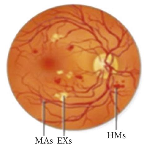 Symptoms of exudates in digital fundus images of diabetic retinopathy ...