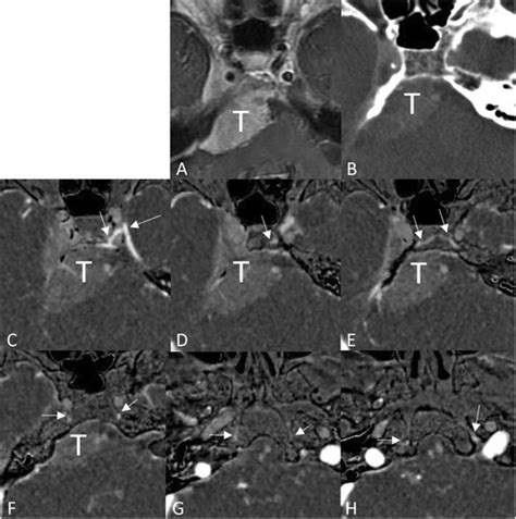 Clival Diploic Vein In A Case Of Petroclival Meningioma A Enhanced T1