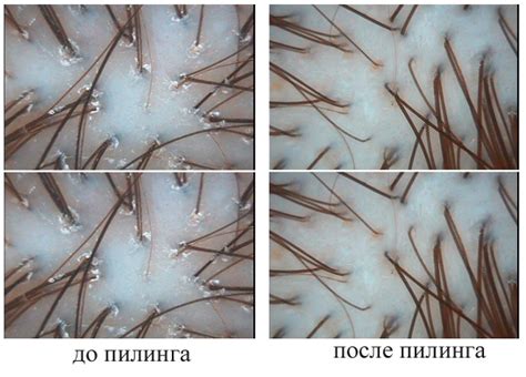Пилинг кожи головы Дерматология плюс: услуги дерматолога, венеролога ...