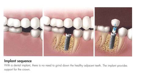 Dental Implants in Hilliard, OH - Hilliard Dentist | Fishinger Dental