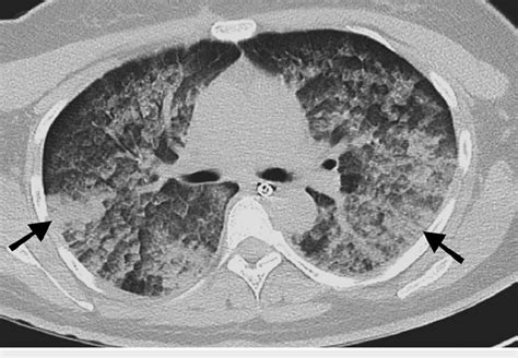 High Resolution Ct Hrct Chest Done On Day 4 Showing Ground Glass