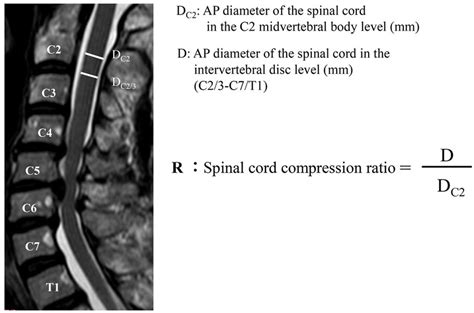 Spinal Cord Compression