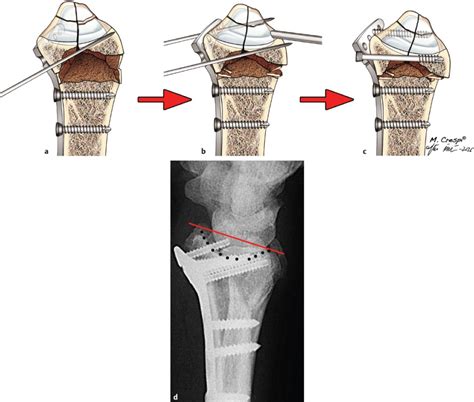 Comminuted Metaphyseal–Diaphyseal Fractures | Musculoskeletal Key