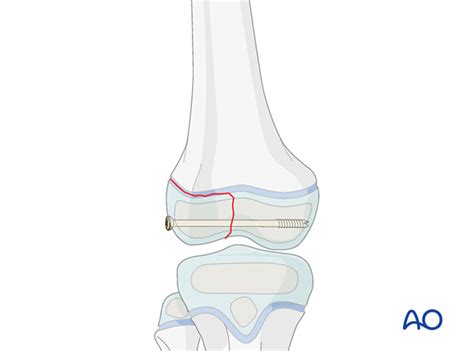 Reduction And Screw Fixation With Arthroscopic Assistance For