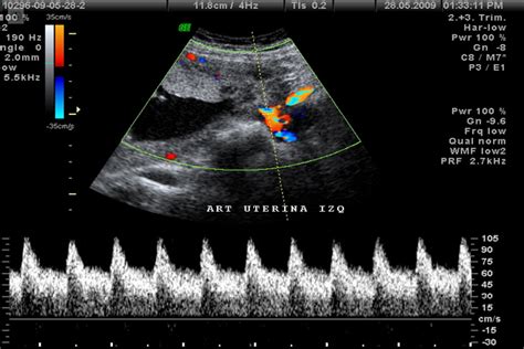 Ecograf A Doppler De Arterias Uterinas Qu Es S Ntomas Y Tratamiento