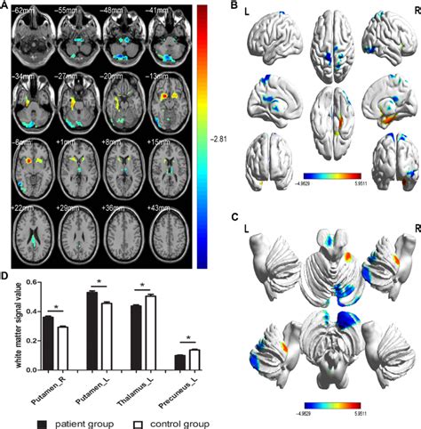 Spontaneous Brain Activity In The Pg Versus Cg A C And The White