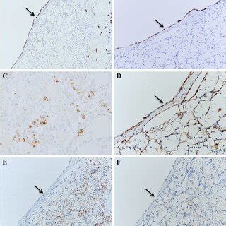 Clear Cell Renal Cell Carcinomas With Cystic Component Similar To