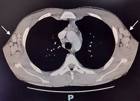 Chest Computed Tomography CT Revealing The Presence Of Lymph Node