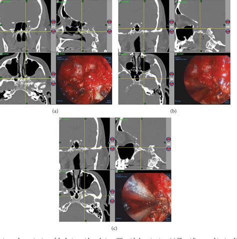 Table 1 From Expanded Endoscopic Endonasal Treatment Of Primary