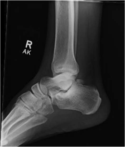 Posterior Ankle Impingement Clinics In Podiatric Medicine And Surgery