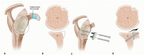 Latarjet Procedure For Instability With Bone Loss Musculoskeletal Key