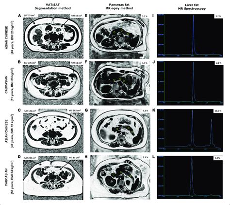 Fat Fraction Maps Obtained From Abdominal Mri Scans Showing