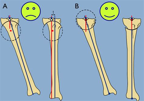 Knee Preservation Paley Orthopedic And Spine Institute