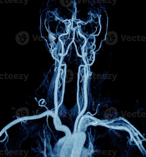 Angiografía Por Resonancia Magnética De Las Arterias De La Vasculatura