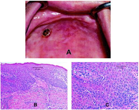 Intraoral Melanoma Long Term Follow Up And Implication For Dental