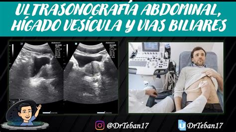 Ecografía Abdominal Drteban17 Udocz