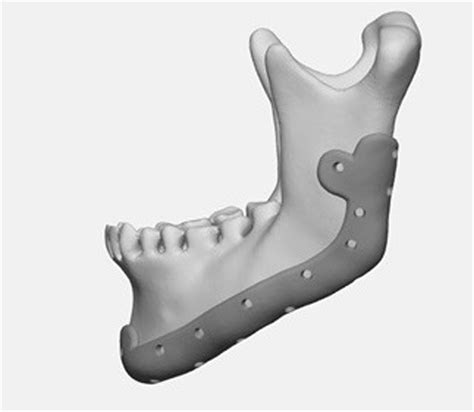 Biomechanical Evaluation Of Caudally And Buccally Screwed Customised