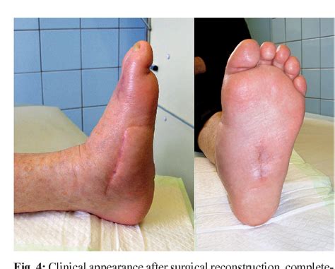 Charcot Foot Reconstruction