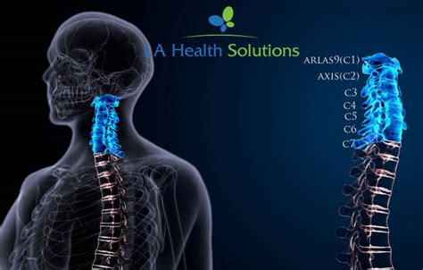 Cervical Radiculopathy La Health Solutions Health News