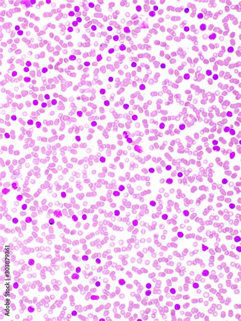 Foto De Picture Of Acute Lymphocytic Leukemia Or All Cells In Blood