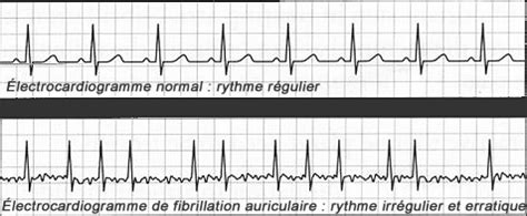 La fibrillation auriculaire La santé est une ressource de la vie