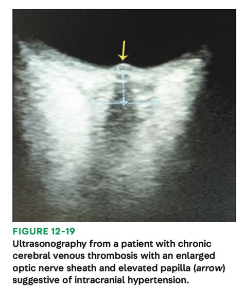 MedClub On Twitter RT CarlosJMoreno Review Neurology POCUS