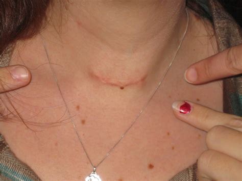The Random Travels Of Kirsi Anneli Evolution Of A Neck Wound