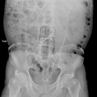 computed tomography scout film showing  fragmented ureteral stent