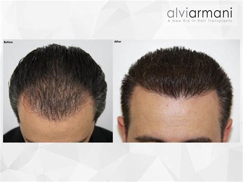 Patient Portfolio Alvi Armani Hair Transplant Los Angeles