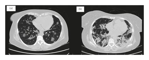 Spiral Chest CT Scans Imaging A Diagnostic Chest CT Scan Showing