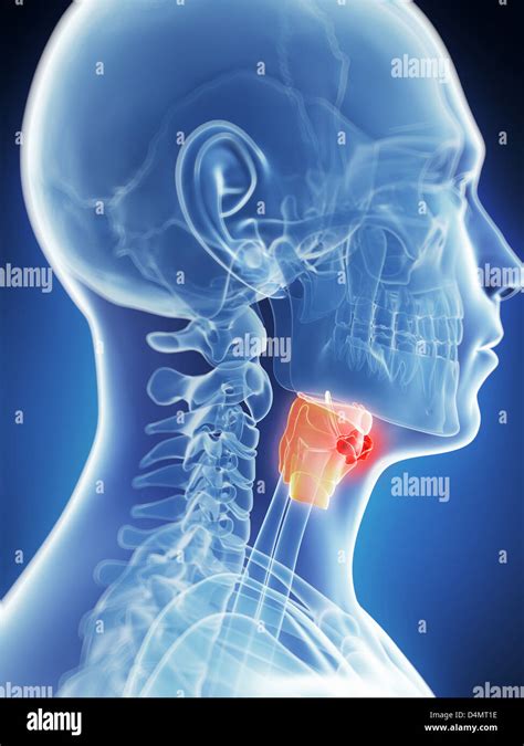 Tonsil Cancer Stage 1