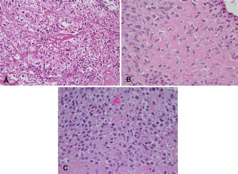 Malignant Bone Tumors Radiology Key