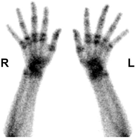 The three-phase bone scan demonstrated diffusely increased blood flow ...