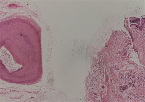 Benign Nevus Cells In The Papillary Dermis Under These Are Bony