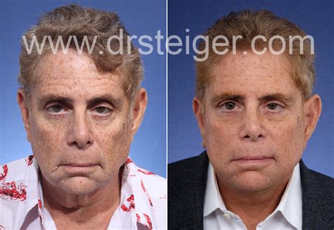 Male Neck Lift Boca Raton Steiger Facial Plastic Surgery Boca Raton