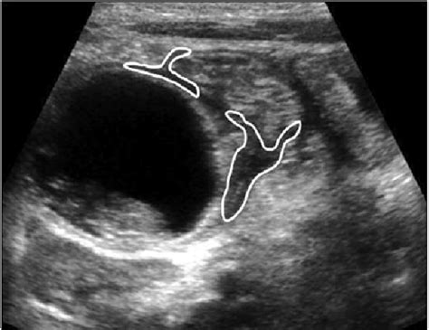 The Cystic Wall Consists Of Inner Hyperechoic And Outer Hypoechoic Download Scientific Diagram